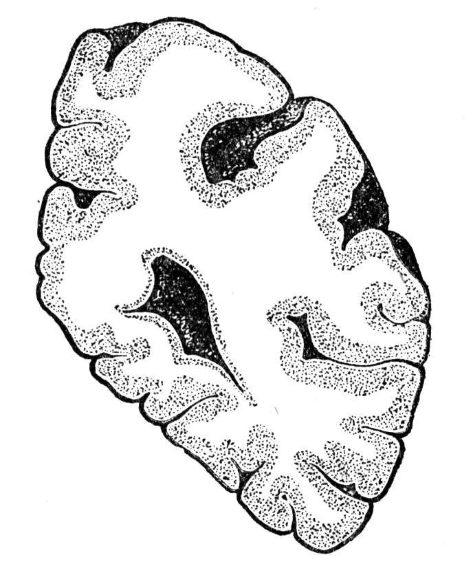 A slice of brain tissue shows both gray and white matter